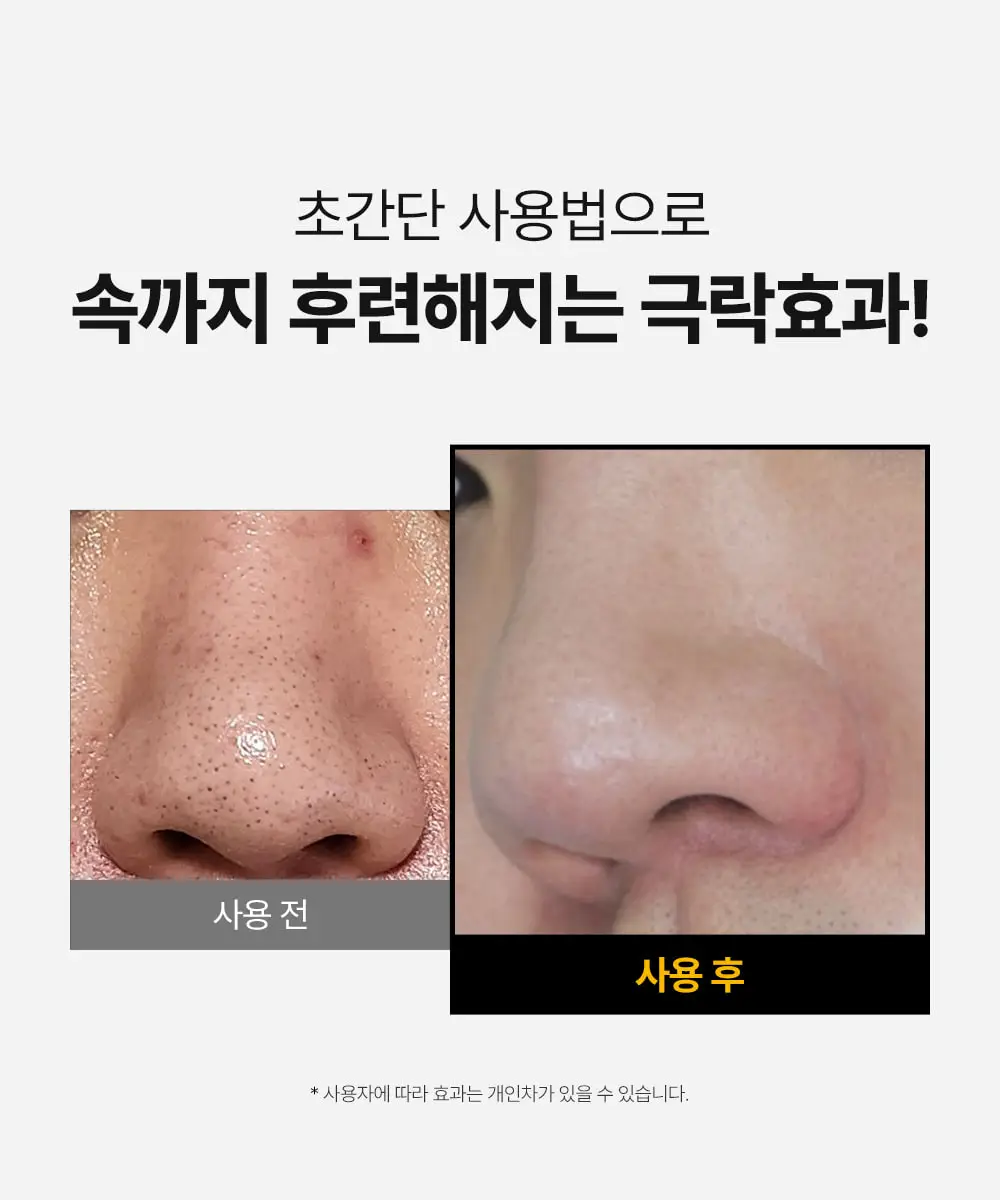 [블랙헤드케어/면봉증정기획] 성분에디터 블랙헤드 멜팅 클리어 패드 기획 (+압출면봉 30개) 상세페이지 10
